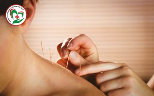 Phương pháp châm cứu có tác dụng giảm đau