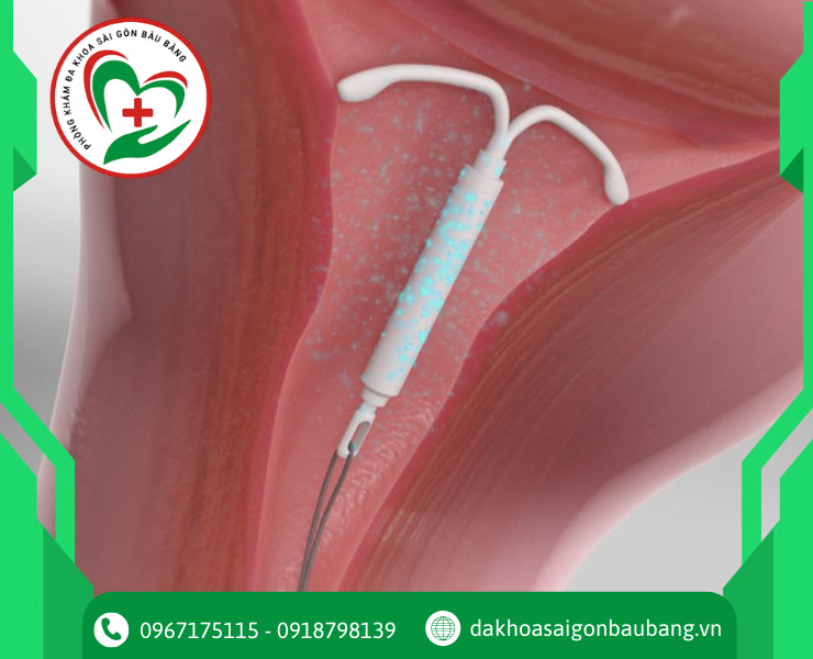 Ưu điểm và nhược điểm của việc đặt vòng tránh thai