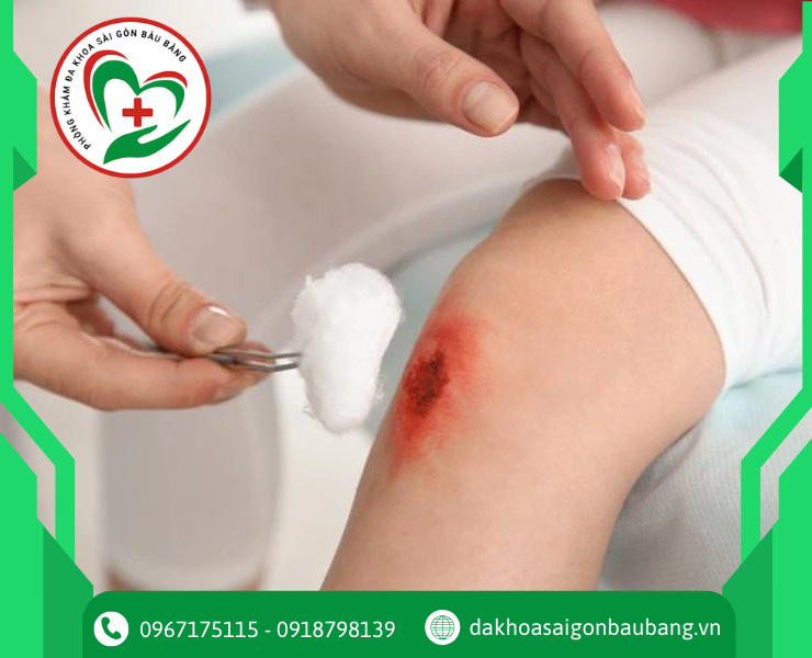 Vết thương hở sâu, không cầm máu