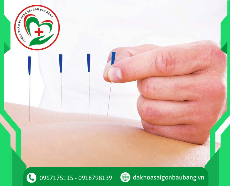 Ứng dụng châm cứu trong điều trị