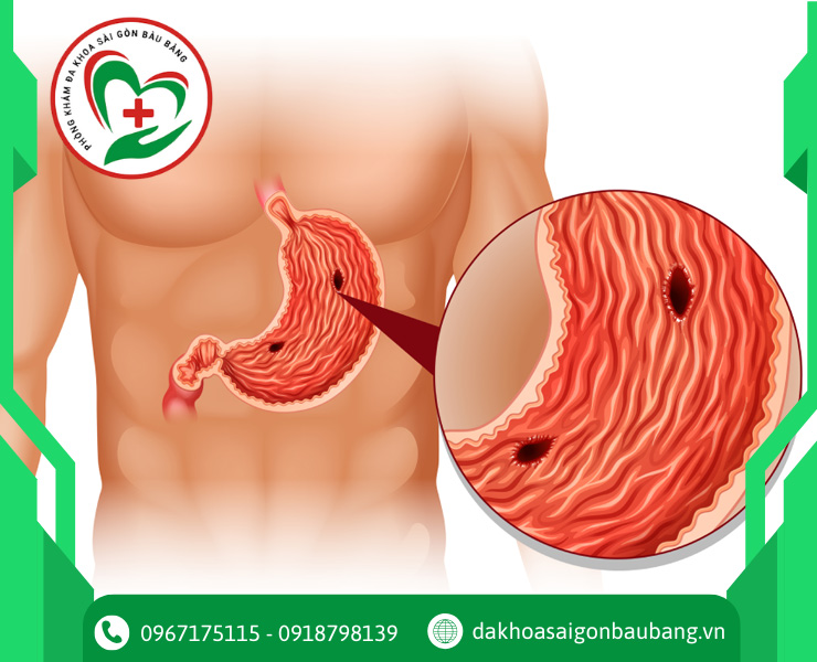 Biến chứng nguy hiểm của viêm loét dạ dày - tá tràng nếu không điều trị kịp thời